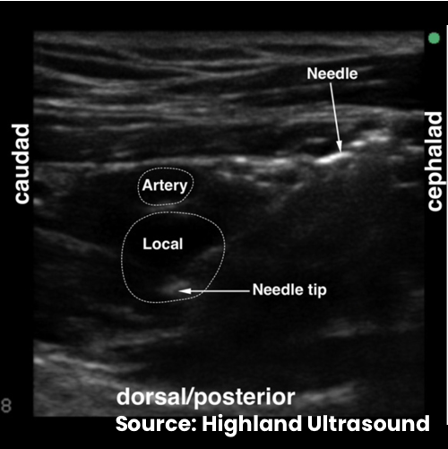Confirmation of ultrasound-guided infraclavicular brachial plexus injection with “double bubble” sign. The dashed line outlines the axillary artery as the top “bubble;” the accumulating local anesthetic after injection posterior/dorsal to the artery is the second “bubble.”