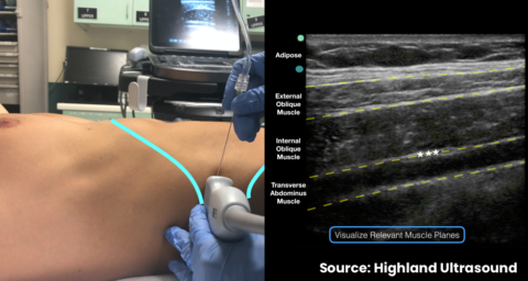 Transversus Abdominis Plane | Nerve Block