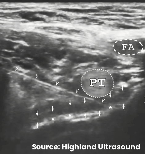 Hypoechoic local anesthetic injectate is seen hydro-dissecting (lifting) the iliopsoas muscle group, psoas tendon, and psoas fascia from the ilium confirming spread in the target plane deep to the psoas fascia. Triangles = block needle, asterisk = needle tip, PT/dotted circle = psoas tendon, IPE = iliopubic eminence, down arrows = psoas fascia, up arrows = anterior surface of the body of the ilium, FA = femoral artery.