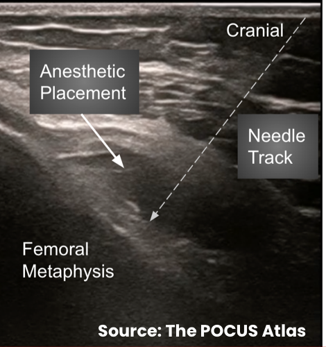 Ultrasound needle trajectory for depositing local anesthetic along the periosteum at genicular nerve target sites.