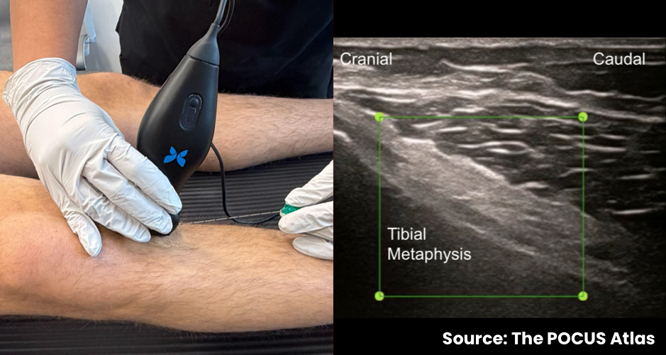 Ultrasound probe position and sonographic view for the inferomedial genicular nerve target at the proximal tibia.