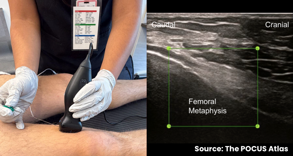 Ultrasound probe positions and sonographic views for superior genicular nerve targets at the distal femur.
