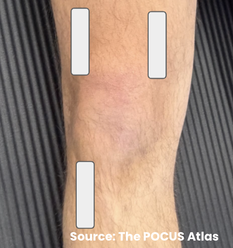 Probe placement diagram for genicular nerve block targets around the distal femur and proximal tibia.