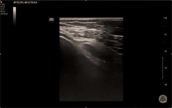 Ultrasound clip demonstrating the femoral genicular nerve target