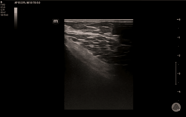Ultrasound clip demonstrating the tibial genicular nerve target