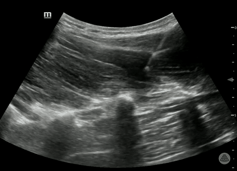 Ultrasound clip demonstrating lumbar erector spinae plane block needle placement and injectate spread.