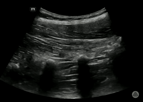 Second ultrasound clip demonstrating local anesthetic spread in the lumbar erector spinae plane.
