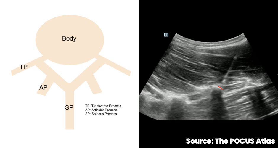 Lumbar vertebral anatomy and corresponding ultrasound target at the corner of the transverse process.