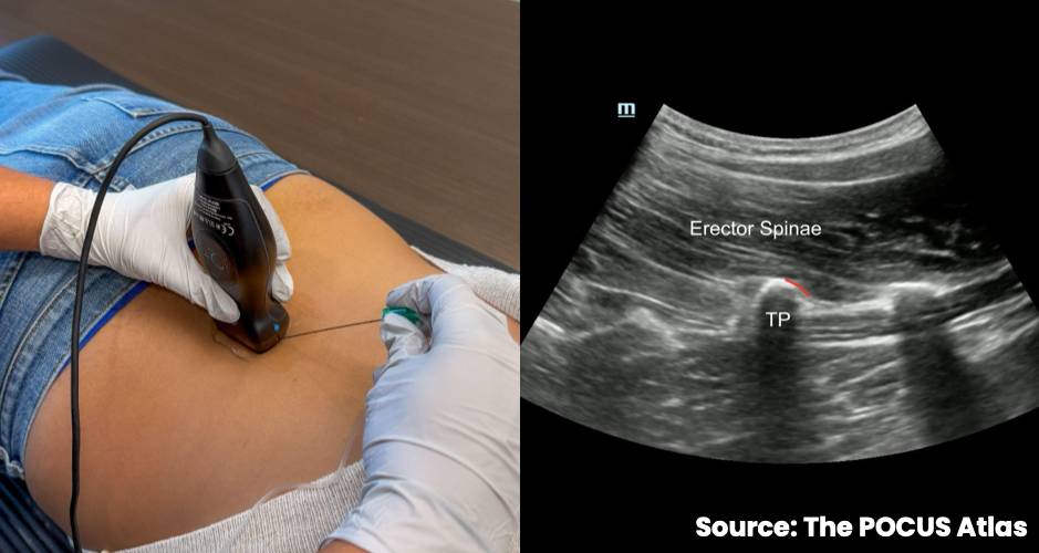 Curvilinear transducer positioned parasagittally over the lumbar spine with ultrasound showing the erector spinae muscle over the transverse process.