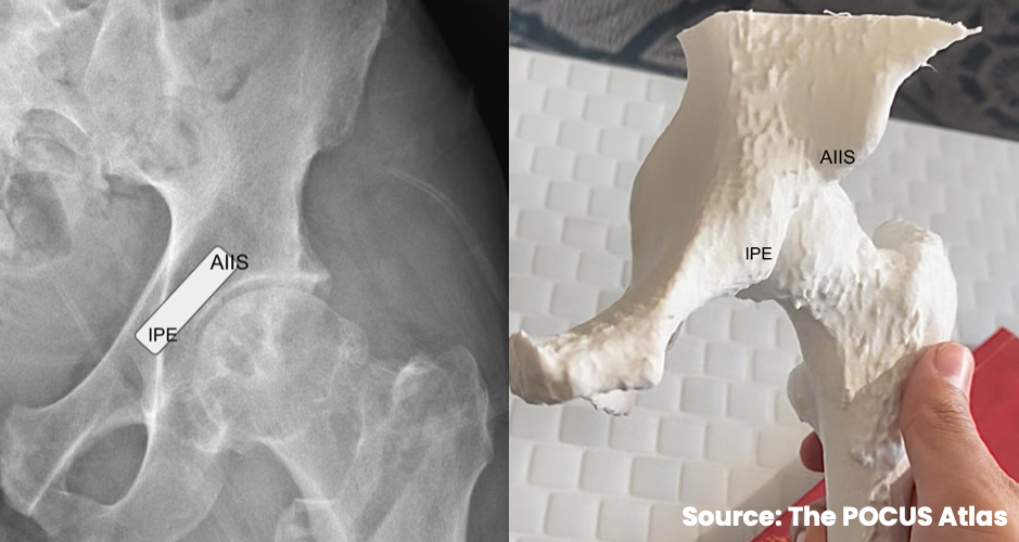 Radiograph and pelvic model identifying the anterior inferior iliac spine and iliopubic eminence for a PENG block