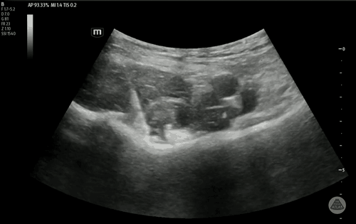 Ultrasound clip demonstrating PENG block needle advancement and injectate spread
