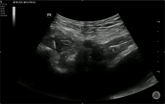 Ultrasound clip demonstrating a PENG block in a distinct alternate view