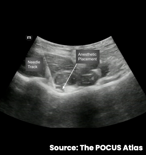 Ultrasound illustration of the in-plane needle track and anesthetic placement for a PENG block