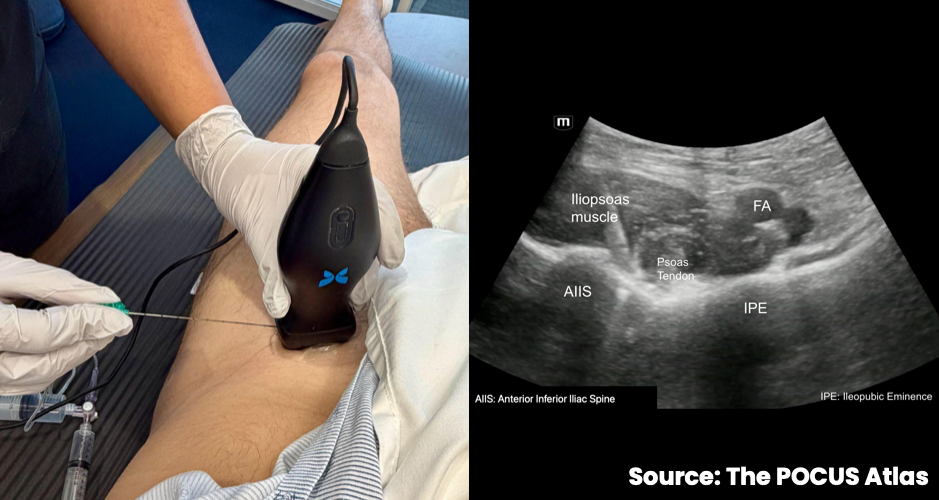 PENG block probe and needle position with the femoral artery, iliopsoas muscle, psoas tendon, anterior inferior iliac spine and iliopubic eminence identified on ultrasound
