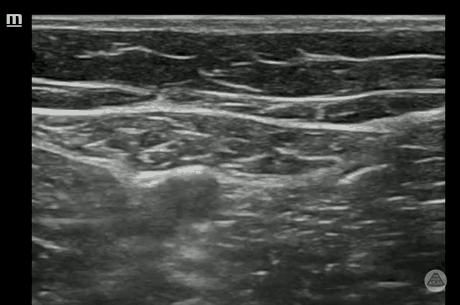 Ultrasound clip demonstrating injectate spread during a saphenous nerve block