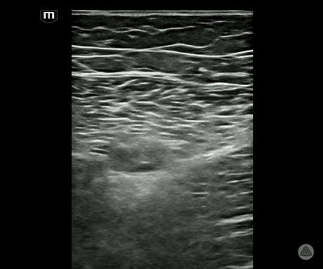 Additional ultrasound clip demonstrating injectate spread during a saphenous or adductor canal block