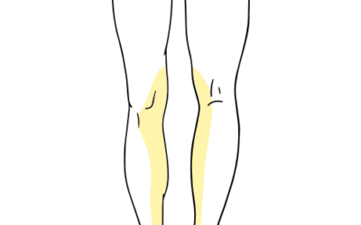 Saphenous / Adductor Canal Block