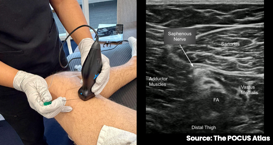 Medial thigh probe and needle position beside labeled distal-thigh ultrasound anatomy for a saphenous nerve block