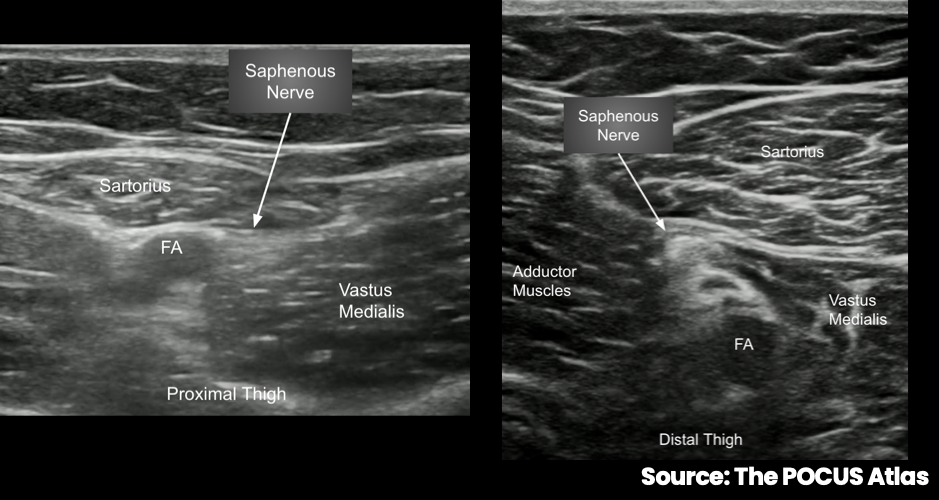 Labeled proximal- and distal-thigh ultrasound views of the saphenous nerve adjacent to the femoral artery