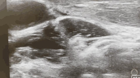 Ultrasound clip demonstrating injectate opening the cervical sympathetic target plane during a stellate ganglion block.