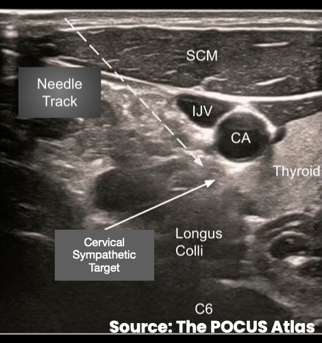 Ultrasound-guided lateral-to-medial needle trajectory toward the prevertebral fascial plane superficial to the longus colli muscle at C6.