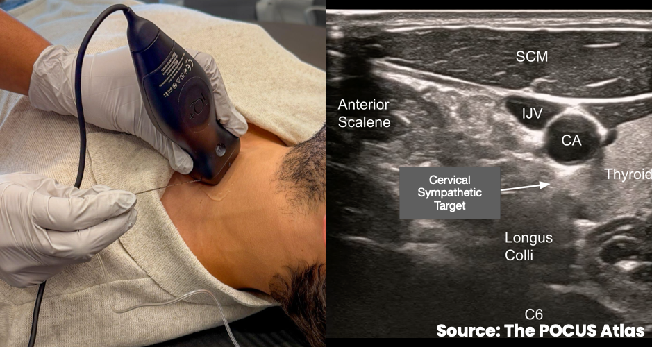 Linear transducer positioned transversely at the left C6 level with ultrasound showing the cervical sympathetic target plane superficial to the longus colli muscle.
