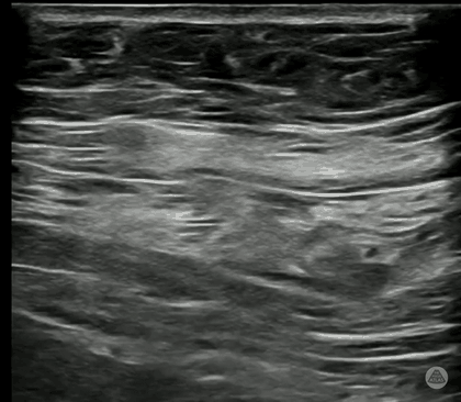 Ultrasound clip demonstrating needle advancement and injectate spread in the transversus abdominis plane