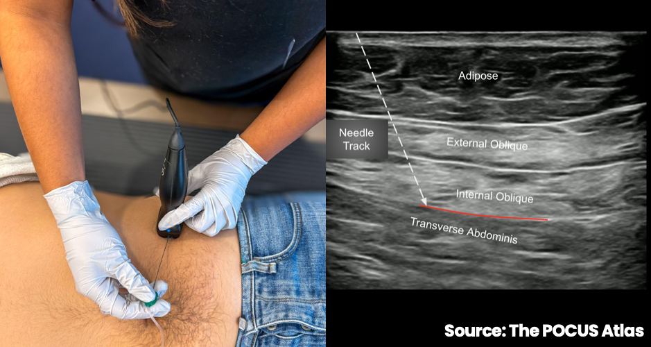 Abdominal wall probe and needle position beside labeled ultrasound anatomy for a transversus abdominis plane block
